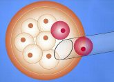 Etwa vier Tage nach der künstlichen Befruchtung besteht der Embryo aus acht Zellen. Ab diesem Zeitpunkt ist eine Erbgut-Analyse möglich - hierfür werden zwei Zellen entnommen.