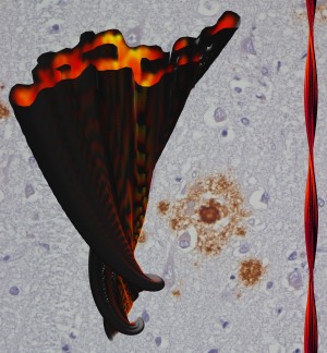 So sieht eine Alzheimer Amyloidfibrille (rot) im Querschnitt aus. Im Hintergrund: Amyloidablagerungen (braun) in Hirngewebe eines Alzheimerpatienten.