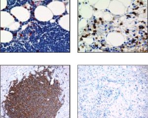 Die Immuntherapie ist offenbar angeschlagen, wie die Bilder aus dem Knochenmark (oben) sowie aus der Leber (unten) vor (links) und nach der Behandlung (rechts) zeigen.In der oberen Reihe sind die Krebszellen in blau, in der unteren in braun zu sehen.