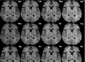 Mithilfe der Magnetresonanztomographie (MRT) lassen sich im Gehirn von MS-Patienten frische Entzündungsherde (weiße Flecken) nachweisen.