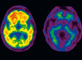 Mit der Substanz Florbetaben lässt sich frühzeitig aufspüren, ob ein Patient an Alzheimer leidet. Der linke Hirnscan zeigt die Proteinansammlungen von Beta-Amyloid (gelb markiert)  im Vergleich zu einem gesunden Gehirn.