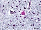 Beta-Amyloid-Plaques im Gehirn eines Alzheimer-Patienten. Was genau die Erkrankung auslöst, ist jedoch immer noch nicht restlos geklärt