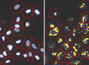 Mikroskopische Bilder menschlicher Neuroblastomzellen. Links: Zellkerne (blaue) und Zellmembran (rote Konturlinien). Rechts: Fluoreszenzmarkierte Aβ-Ablagerungen (gelb).