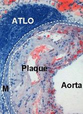 ATLO in der Abdominalaorta einer ca. 20 Monate alten an Arteriosklerose erkrankten Maus. Die Lymphozyten in der Gefäßaussenwand wurden mit Hämatoxylin blau angefärbt. Lipidablagerungen sind in rot dargestellt.