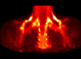 Braunes Fettgewebe ist die Notheizung des Körpers für besonders sensible Bereiche, bei Kälte wird es zugeschaltet und leuchtet in dieser Aufnahme durch die Positronen-Emissionstomographie.