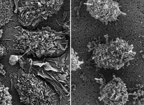 Elektronenmikroskopische Aufnahme von gesunden Fresszellen (links) und mit Streptococcus pyogenes infizierten Fresszellen. Die infizierten Immunzellen runden sich ab - ein erstes Anzeichen ihres Absterbens.