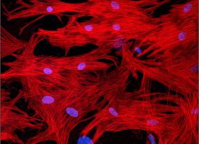 Herzmuskelzellen entwickeln sich im kranken Herzen mit Hilfe von Oncostatin M zurück. Die Myofibrillen sind rot gefärbt, Zellkerne blau.