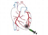 Bei der Rostocker Stammzelltherapie werden körpereigene Knochenmarkszellen direkt in den durch einen Infarkt geschädigten Herzmuskel gespritzt. 