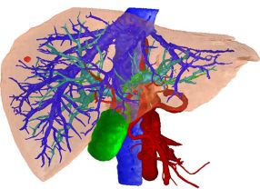 Dreidimensionale Darstellung einer Leber mit Blutgefäßen (rot und blau) sowie den Gallengängen und der Gallenblase (grün).