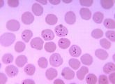 Der Erreger Plasmodium falciparum dringt in rote Blutkörperchen ein und zerstört sie.