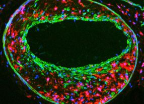 Fluoreszenzmikroskopische Aufnahme eines Gewebschnitts durch die Arterie einer microRNA 143/145-Knockout-Maus. Das Gefäß ist krankhaft erweitert und mit Abwehrzellen des Immunsystems (rot) gefüllt.