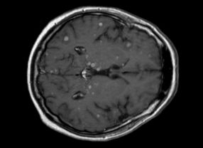 MRT eines Gehirns mit Krebsmetastasen