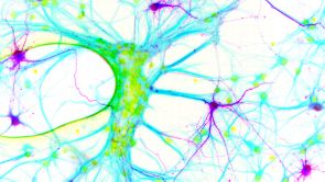 Um zu erkennen, welche Nervenzellen im neuronalen Netzwerk den veränderten Glycinrezeptor herstellen, habenForscher einen zusätzlichen Genabschnitt eingeschleust, der für ein Fluoreszenzprotein kodiert und die Nervenzellen aufleuchten lässt (lila dargestellt). 