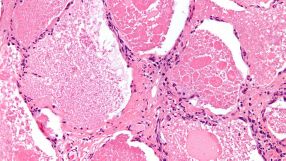 Bei der Lungenkrankheit PAP sind die Fresszellen nicht in der Lage, Proteine und Fette abzubauen. (Mikrofoto von Alveolarproteinose)