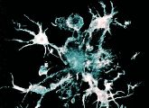 Körpereigene Immunzellen (Mikrogliazellen; weiß), fressen das giftige Alzheimer-Eiweiß Amyloid im Gehirn.