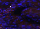 Von Rostocker Wissenschaftlern identifiziert: CD8+AT2R+ T-Zellen (Pfeile) im infarzierten Herz einer Ratte.